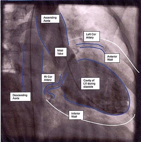 Ventriculography (LV Gram) 